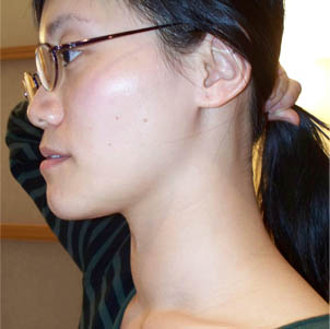 Olive Yu's Thyroid Before